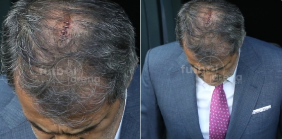 Şenol Güneş'in kafasındaki dikişlerin son hali - Görsel 5